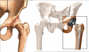 Modular hip joint replacement and its interlocking surface. b) stem surface, c) tibial head surface.